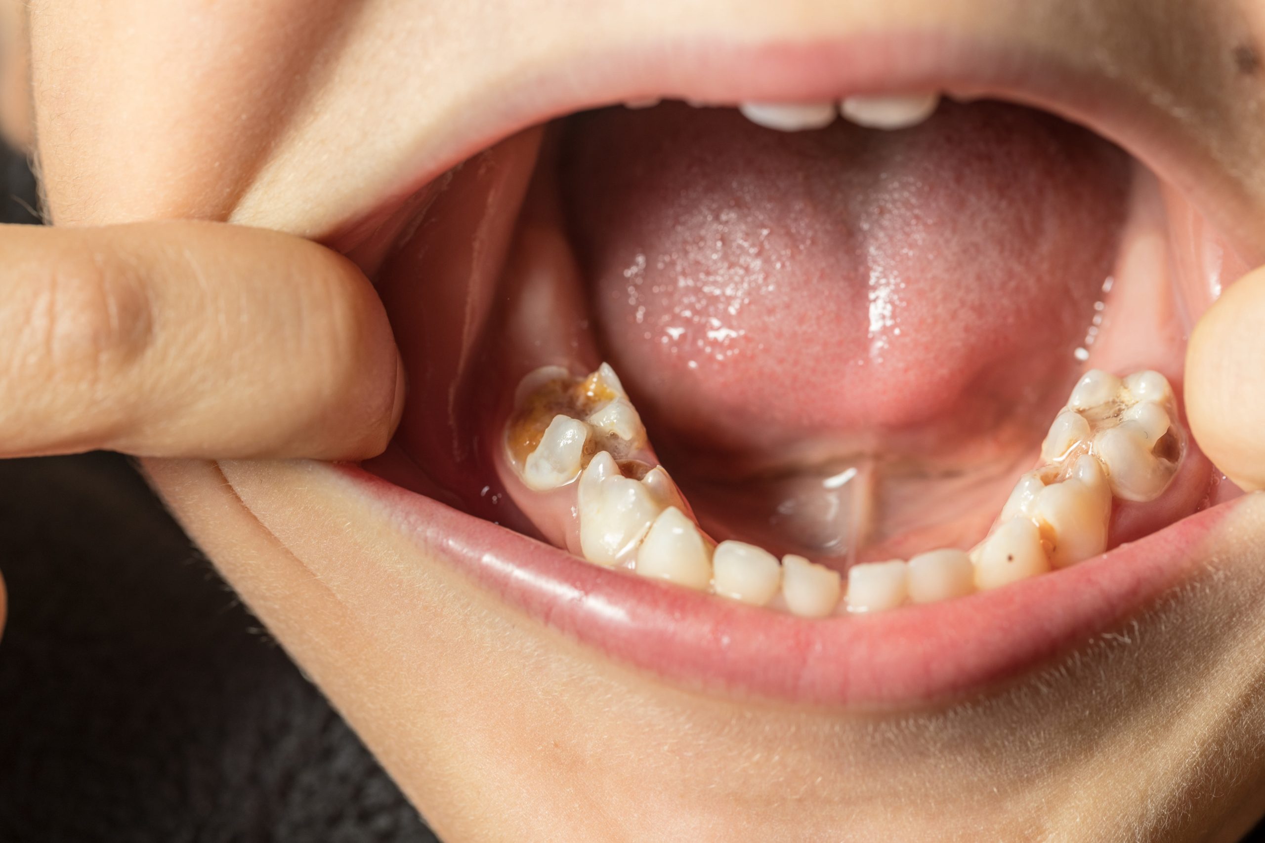 HIGH LEVELS OF TOOTH DECAY AMONG CHILDREN IN HULL